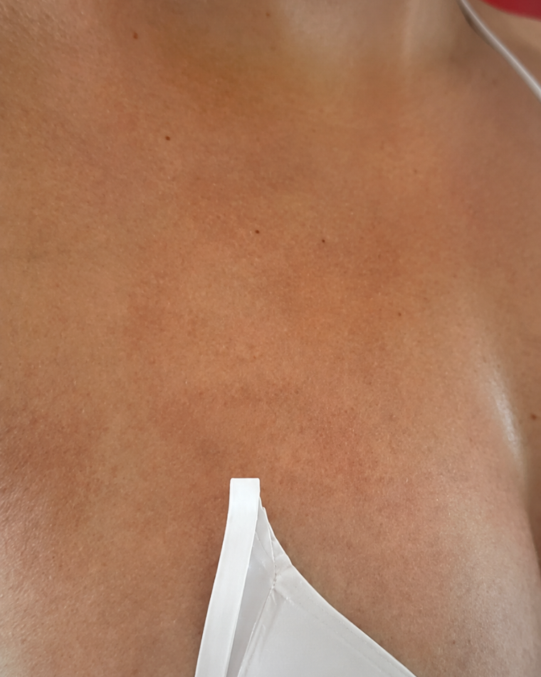 Antes do bronzeamento